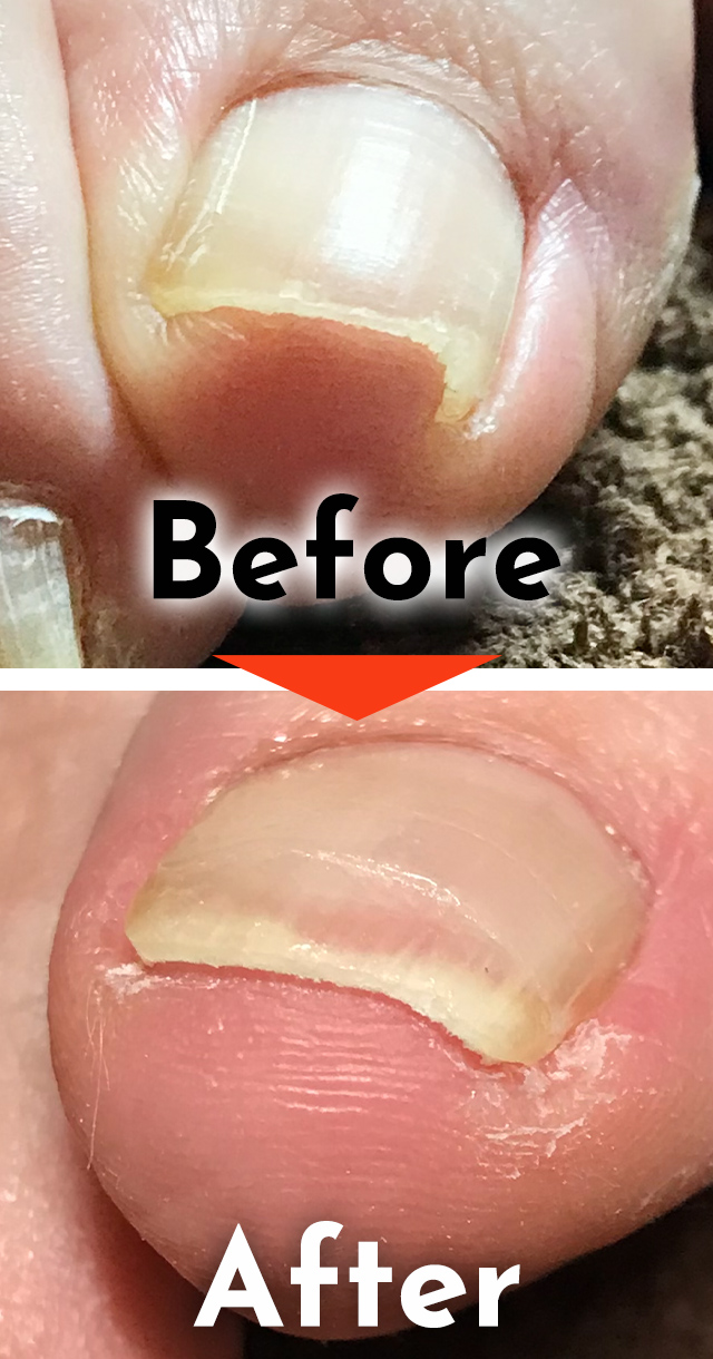 巻き爪施術のビフォーアフター