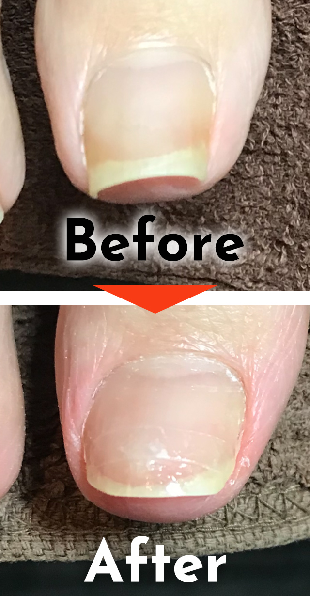 巻き爪施術のビフォーアフター